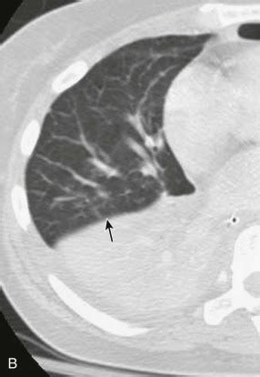 The Air Bronchogram Sign | Radiology Key