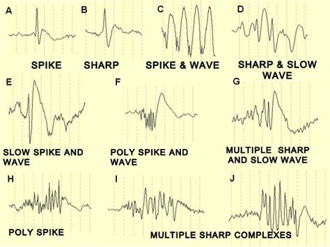 27+ Epilepsie Eeg Spikes