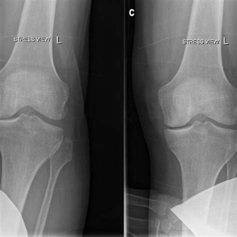 Group 2 preoperative radiographs. a) 15° AP; b) varus stress view; c)... | Download Scientific ...