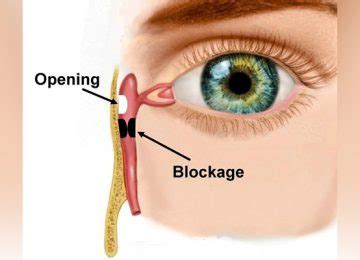 DCR Archives | Basir Eye Center