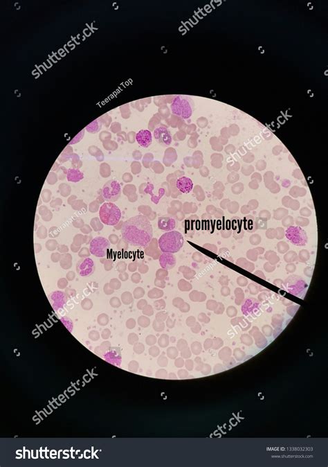 Promyelocyte Myelocyte Wbc Stock Photo 1338032303 | Shutterstock