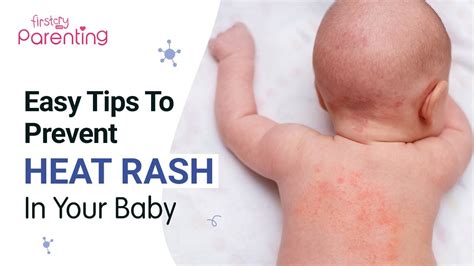 How to Treat and Prevent Heat Rash in Babies - YouTube