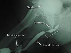 Urethral Stricture Diagram