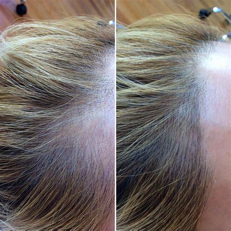 What Is Scalp Microblading? Everything You Need to Know About Semi ...