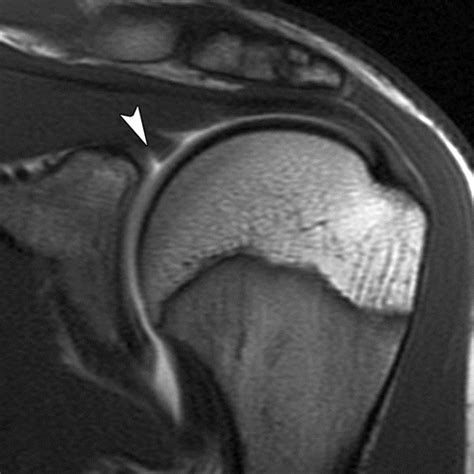 Mri Shoulder Labrum Tear