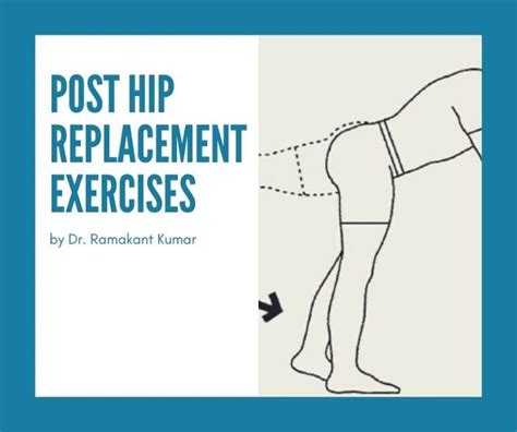 6 Best Post Hip Replacement Exercises | Dr. Ramakant Kumar