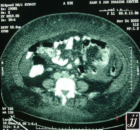 Anasarca edema – Radiopaedia