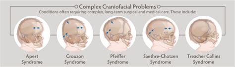 Craniofacial Anomalies | Craniofacial Conditions & Surgeries - AAOMS Oral and Maxillofacial Surgeons