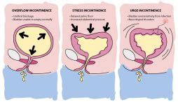 What Causes Urge Incontinence? Davies Urology Hamilton