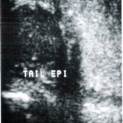 USG image showing enlargement of the prostate with abscess formation in... | Download Scientific ...