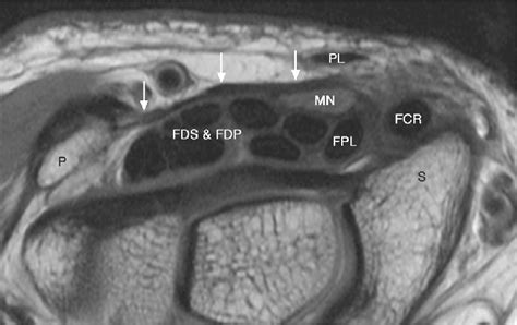 Wrist Anatomy Mri