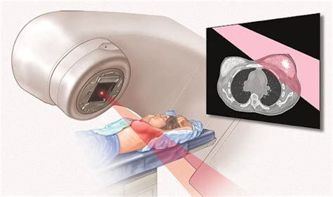 Radiation Therapy: Cost, Types, Risks, & Procedure