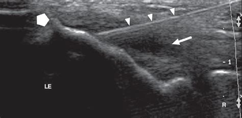 Ultrasound of common extensor tendon during needle placement in... | Download Scientific Diagram