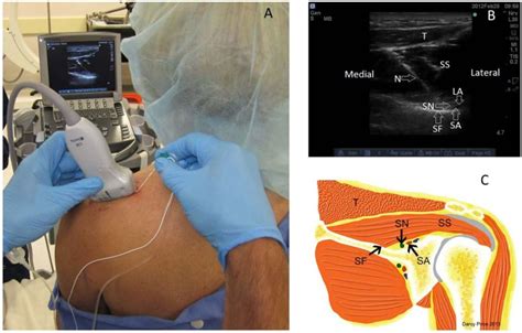 Suprascapular Nerve Block