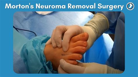 Morton's Neuroma Removal Surgery - YouTube