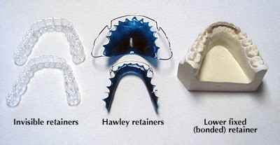 Orthodontic Retainers Maintain Smiles | McNamara Orthodontics