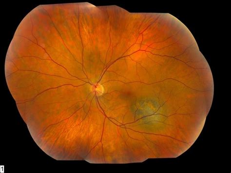 Choroidal Melanoma With Pigment - Retina Image Bank