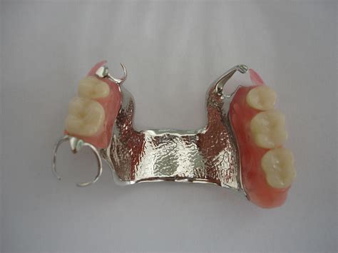 Rene Dental Lab: METAL PARTIAL DENTURES