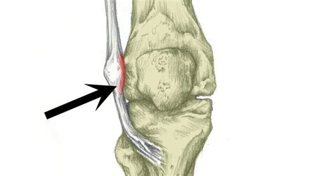 Iliotibial Band Syndrome (Runners Knee) - Sportsinjuryclinic.net