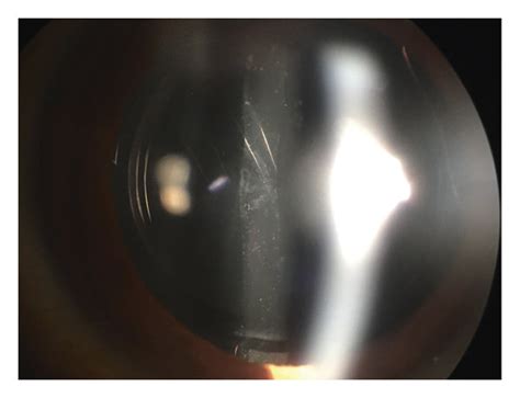 PCO grades by slit-lamp examination and a Volk 90D lens in this study ...