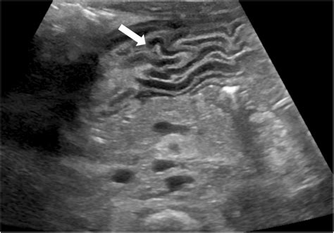 Foveolar hyperplasia in a 3-month-old boy with congenital cardiac... | Download Scientific Diagram