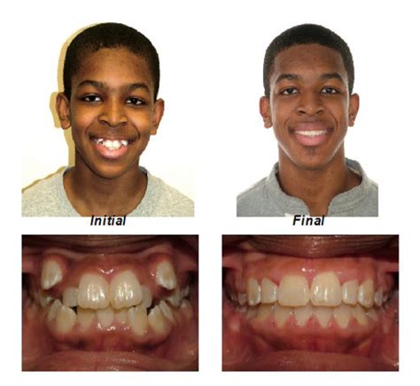 orthodontic treatment overcrowded teeth