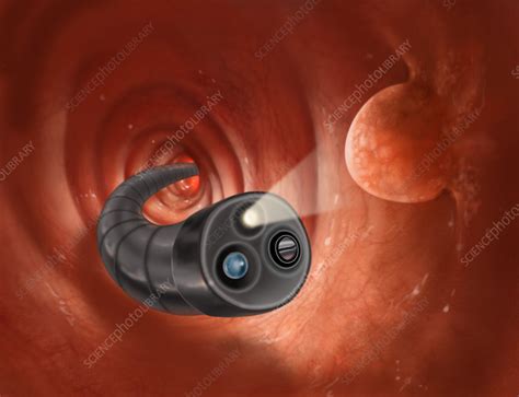 Colonoscopy with Polyps - Stock Image - C022/1033 - Science Photo Library