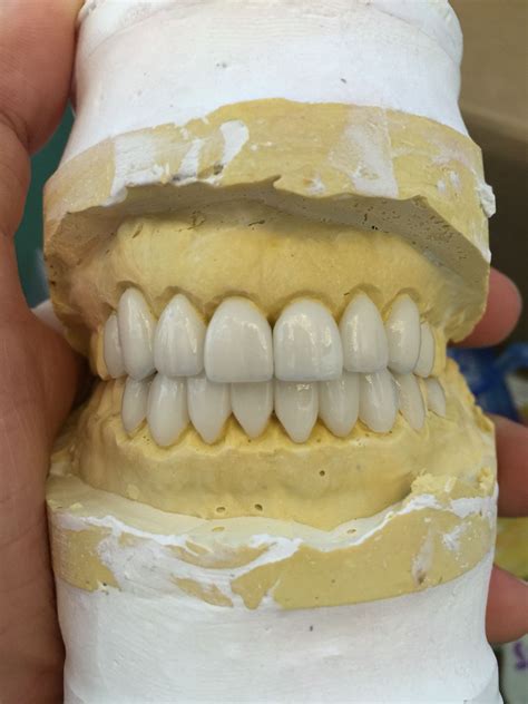 All porcelain emax veneers on the model before delivery Dentistry Education, Dentistry Student ...