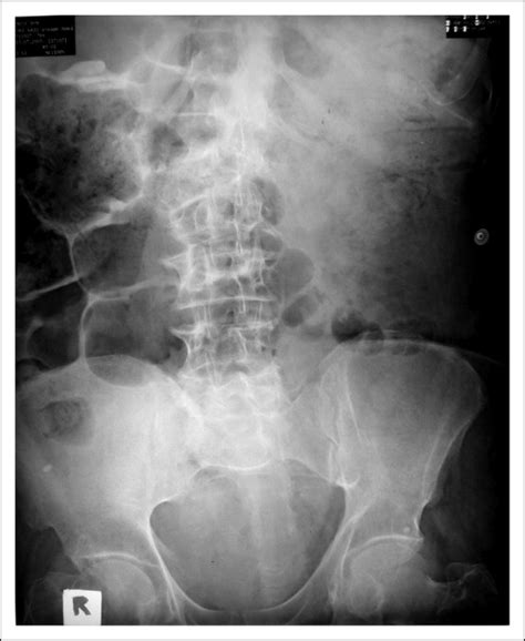 Distended urinary bladder and diverticulum—a rare cause of large-bowel ...