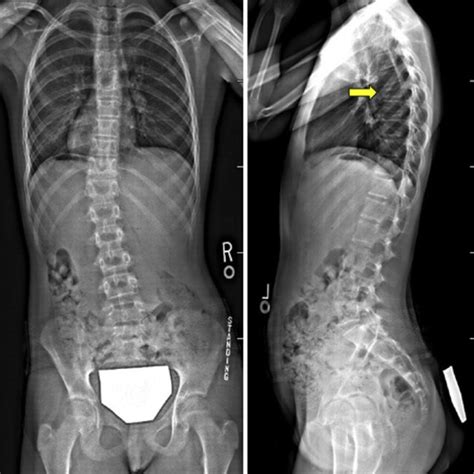 Thoracic MRI at first visit shows compression fractures of T4, T7 and... | Download Scientific ...