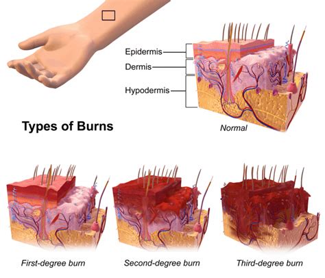 Burns - almostadoctor