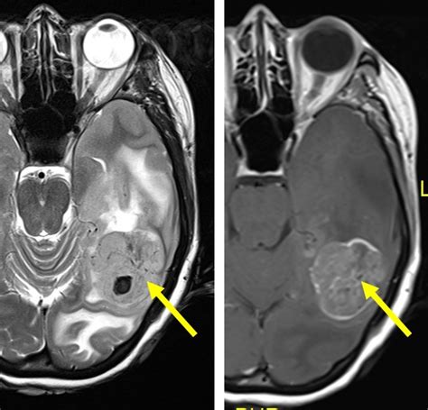 Anaplastic astrocytoma – Radiology Cases