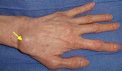 WRIST OSTEOARTHRITIS (Scapholunate Advanced Collapse) | Hand Surgery Source