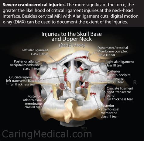 Craniocervical ligament injuries: Focus on the alar ligament – Caring Medical Florida in 2021 ...