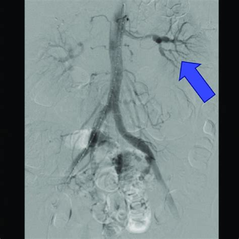 Aortogram with bilateral pelvic runoff demonstrated beads on a string... | Download Scientific ...