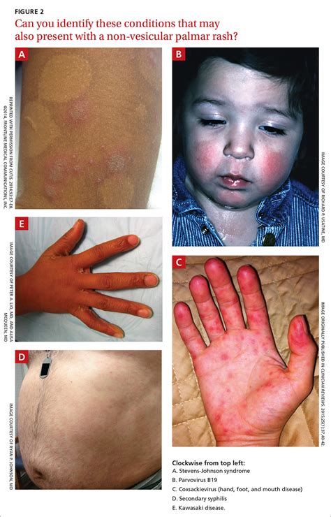 Mildly pruritic palmar rash | MDedge Family Medicine