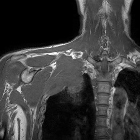 Brachial plexus tumor | Philips MR Body Map