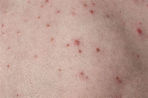 9 Common Bacterial Skin Infections