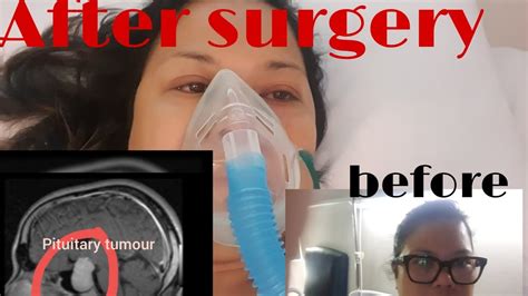 PITUITARY TUMOUR 3.5CM SURGERY - YouTube