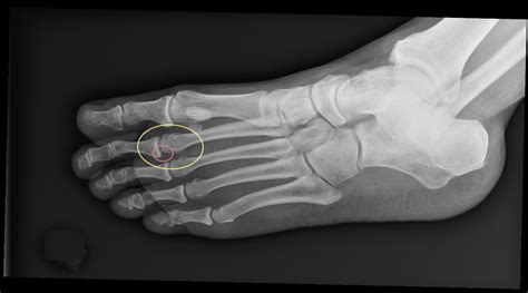 plantar plate ligament Archives - DOC