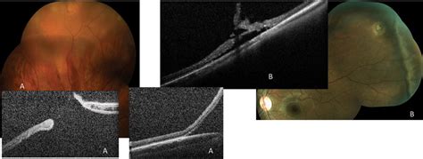 A Field Guide to Retinal Holes and Tears