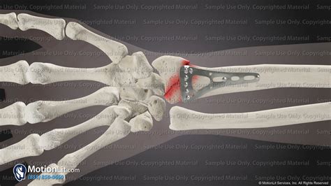 Closed Reduction & Percutaneous Pinning of Thumb - MotionLit