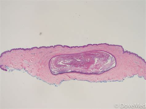 Epithelial Inclusion Cysts of Skin