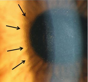 Corneal Guttata Retroillumination