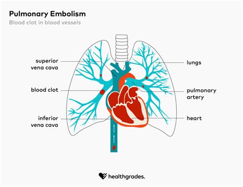 Pulmonary Embolism: Symptoms, Causes, and Treatments