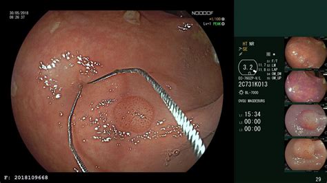 Polypectomy of Small Polyps – ESGE Guideline Recommends Cold Snare Polypectomy (CSP) - Endoscopy ...