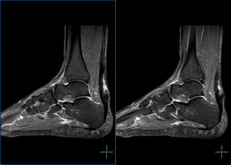 Mri Musculo Skeletal Section Partial Tear Tendon Achilles | sexiezpix Web Porn