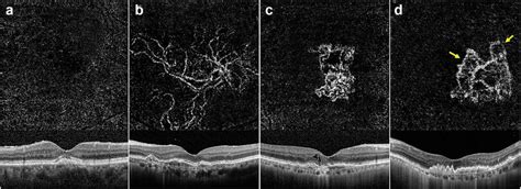 Optical coherence tomography angiography (OCTA) images (3 × 3 mm) with... | Download Scientific ...