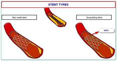 FACTS ABOUT STENT SURGERY TO THE HEART (ANGIOPLASTY OR PTCA OR PCI ...