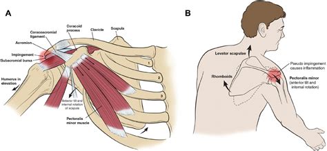 Scapular Dyskinesia - Dr. Rahul Bade